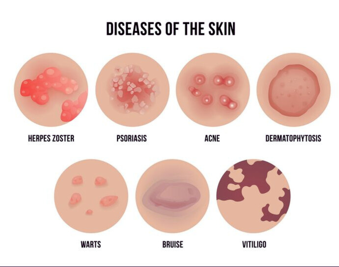 FOCUS KEYPHRASE SKIN INFECTION