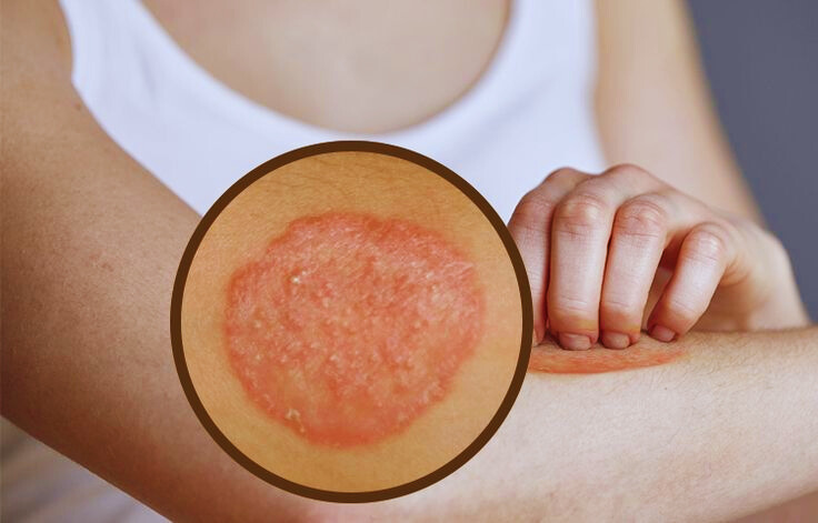 SKIN INFECTION