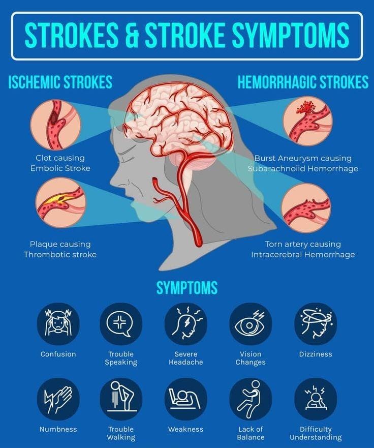 Brain Stroke