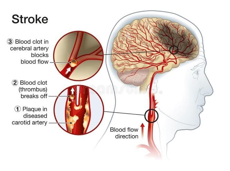 type of stroke