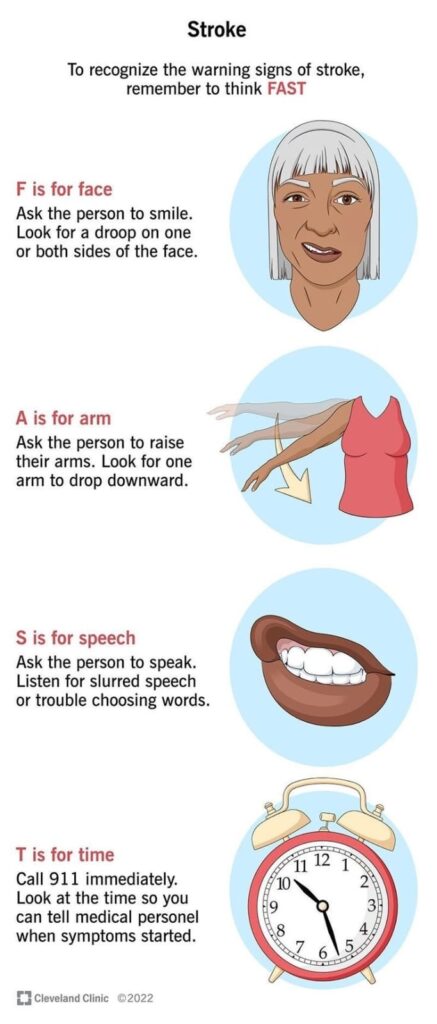 Brain Stroke Symptoms