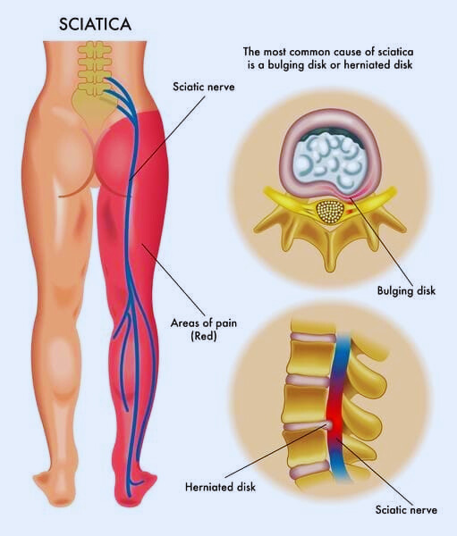 What is Sciatica