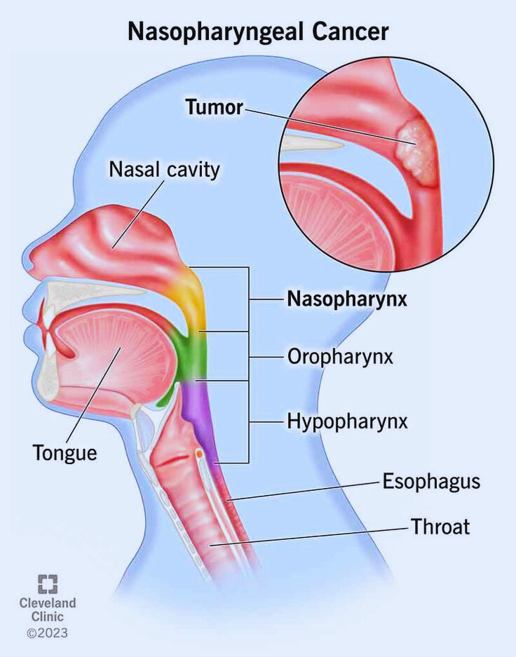 NASOPHARYNGEAL CANCER