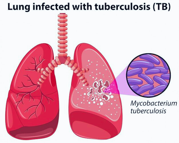 Tuberculosis (TB): Complete information on symptoms, causes, prevention and treatment